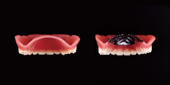 保険の入れ歯との厚みの比較