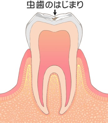 C0：虫歯の始まり