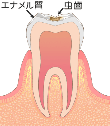C1：軽度の虫歯（エナメル質に限局した虫歯）