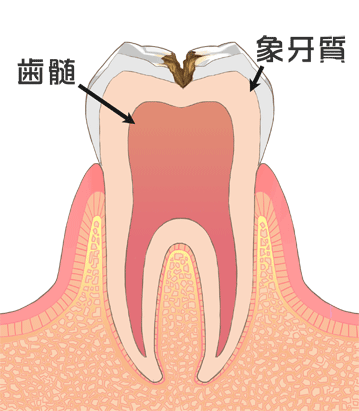 C2：中程度の虫歯（象牙質までおよぶ虫歯）