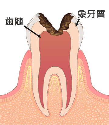 C3：重度の虫歯（歯に神経にまでおよぶ虫歯）