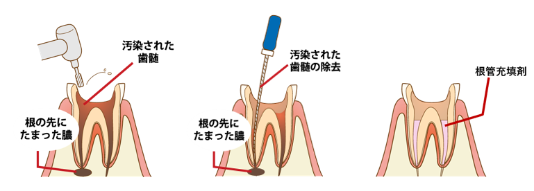 C4：歯を残すことが難しい虫歯（根っこまでおよんだ虫歯）